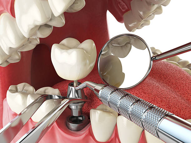 Best Emergency Broken Tooth Repair in Alexandria, KY